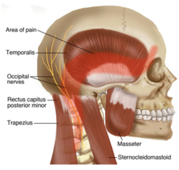 Headaches and Physical Therapy Forward Motion Physical Therapy